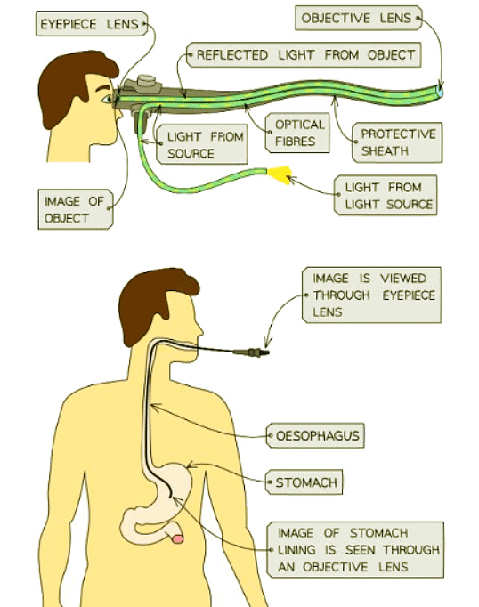 Endoscopes utilise total internal reflection to see inside a patient`s body