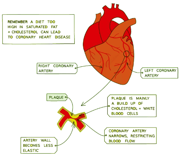 Buildup of plaque in the coronary arteries