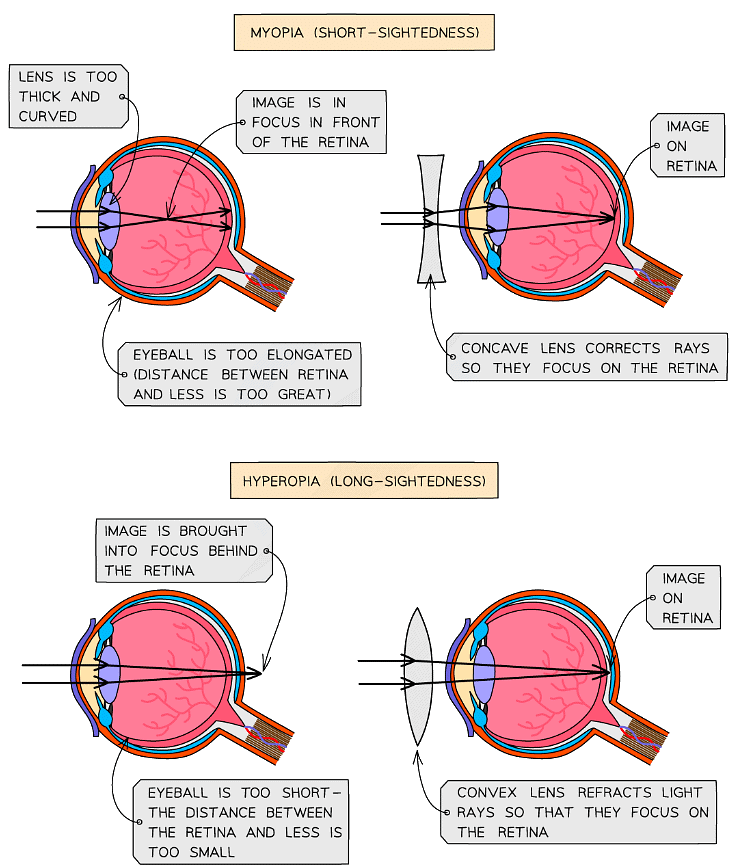 Myopia (short-sightedness) and hyperopia (long-sightedness)