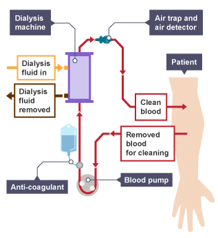 How dialysis works