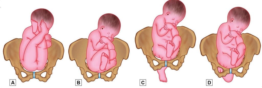 Types of breech presentations. A. Frank breech; B. Complete breech; C. Footling presentation and D. Knee presentation
