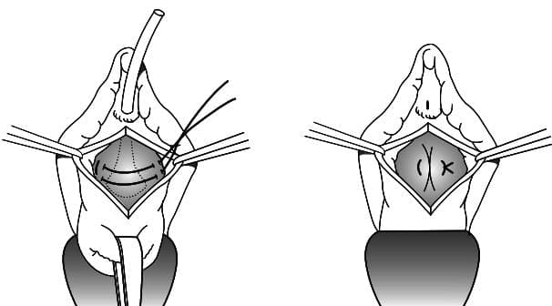 Posterior vaginal wall prolapse