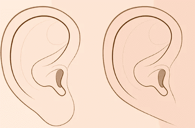 Attached and Free Ear Lobe