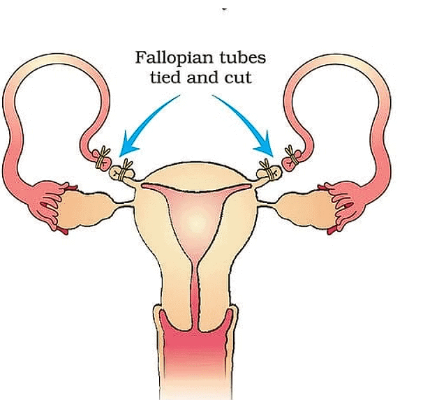Tubectomy