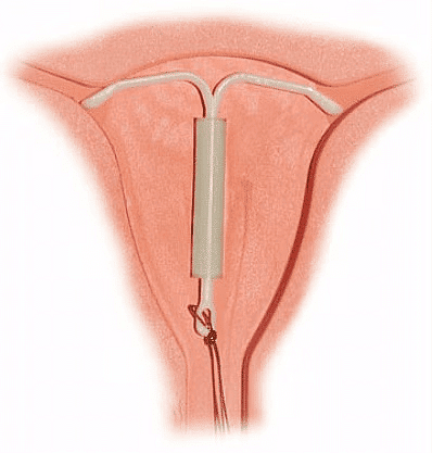 NEET Previous Year Questions (2014-2024): Reproductive Health | Biology Class 12