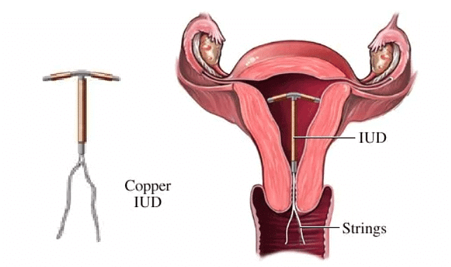 NEET Previous Year Questions (2014-2024): Reproductive Health | Biology Class 12