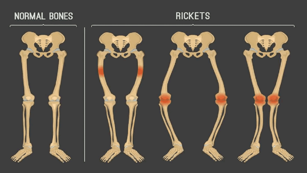 Normal Bones & Rickets