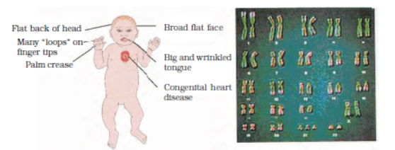 A representative figure showing an individual inflicted with Down’s syndrome and the corresponding chromosomes of the individual
