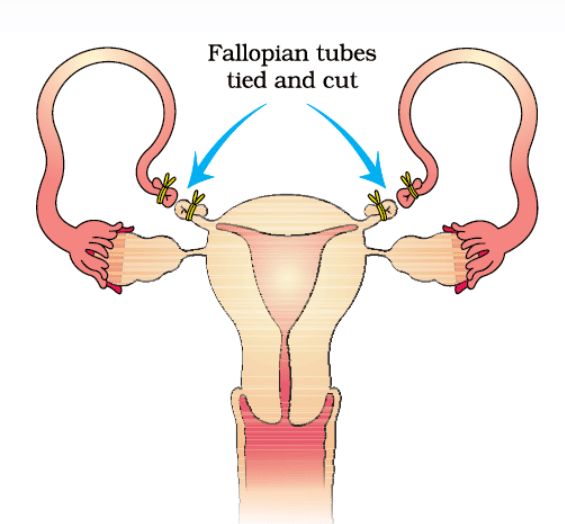 Tubectomy (Female Sterilization)