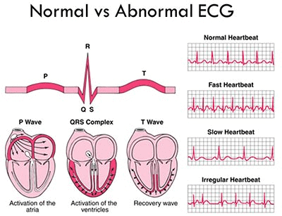 Electrocardiogram