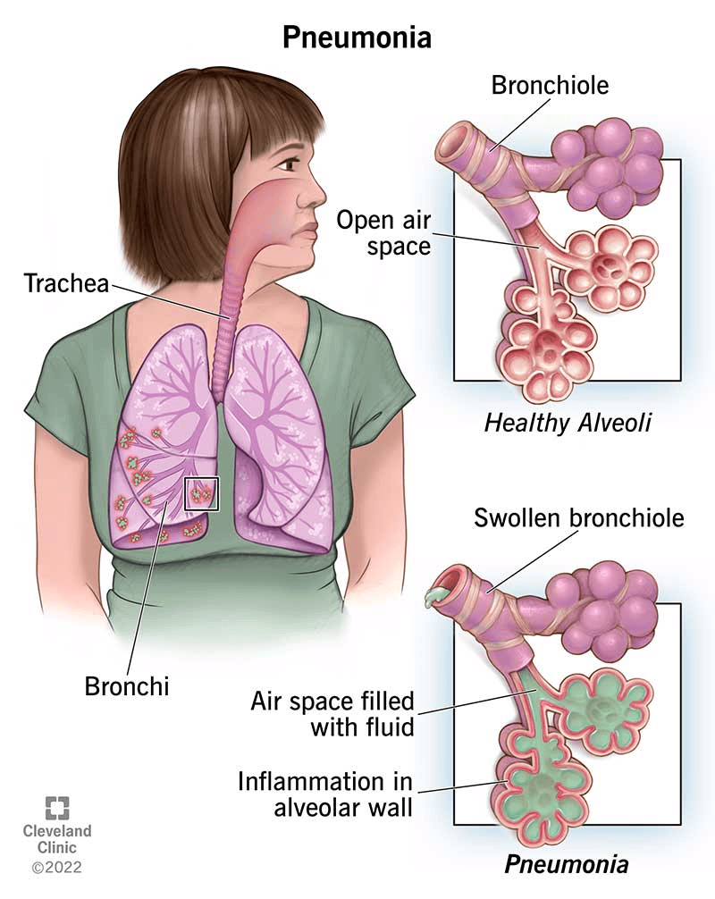 Human Health and Diseases Chapter Notes | Biology Class 12 - NEET