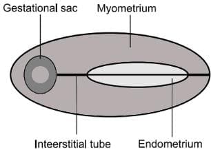 Interstitial ectopics