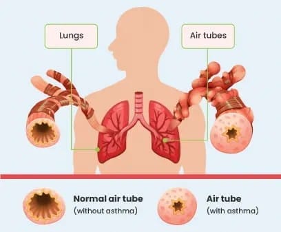 1. Bronchial asthma