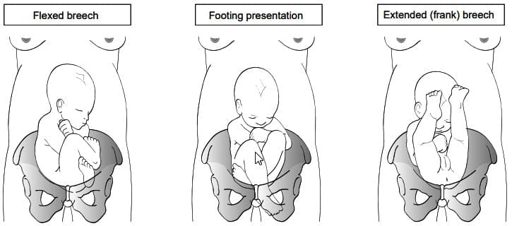 Antenatal management
