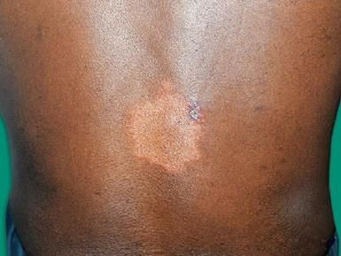 Hansen’s Disease Chapter Notes | Dermatology and Venereology - NEET PG