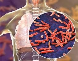 Tuberculosis Incidence Falling in India by 21% a Year: WHO Report
