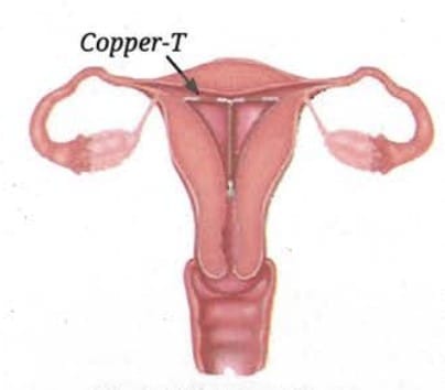 11.5.10 How Can Unwanted Pregnancies and Infections Be Prevented?