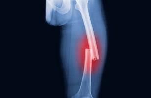 Bone Fracture Treatments | Orthopedic Specialists of Seattle