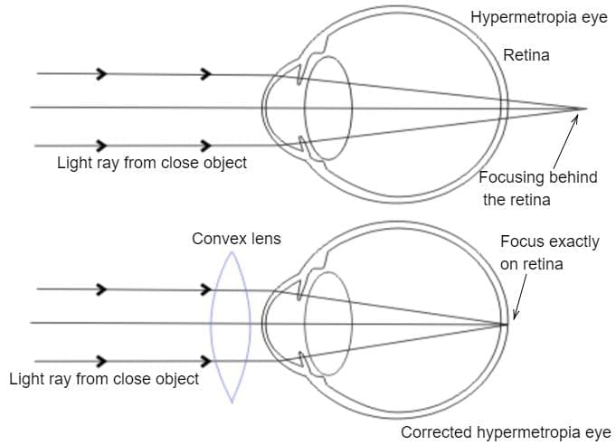 Q2: A person has to keep reading material much beyond 25 cm (say at 50 cm) from the eye for comfortable reading. Name the defect of vision he is suffering from. List two causes responsible for arising of this defect. Draw a labelled diagram showing correction of this defect using eye-glasses. Are these glasses convergent or divergent of light? &nbsp;(3 Marks)