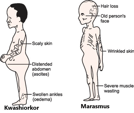 Protein Energy Malnutrition Diseases