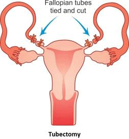 NEET Previous Year Questions (2014-2024): Reproductive Health | Biology Class 12