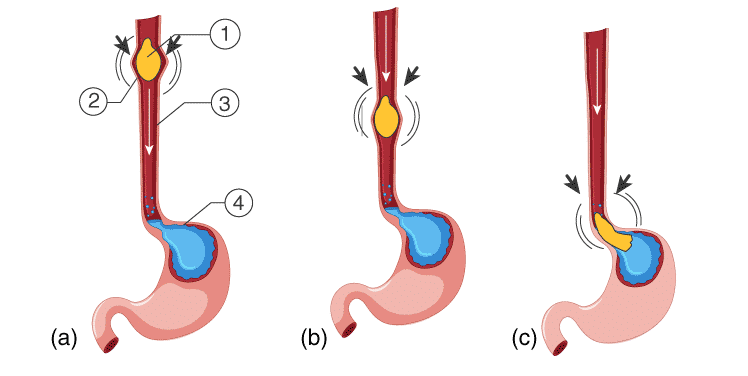 Esophageal Peristalsis1: Food 2: Peristaltic wave 3: Oesophagus 4: Stomach 5: Intestine