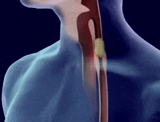 Peristalsis in Oesophagus