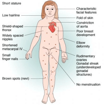 Turner’s Syndrome