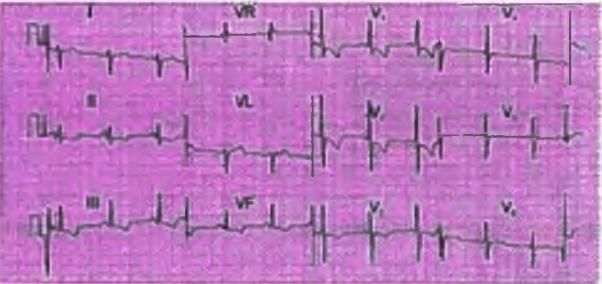 Cardiology Chapter Notes | Medicine - NEET PG
