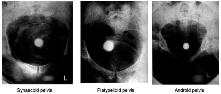 Cephalopelvic disproportion