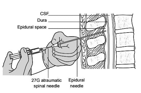 Needle-through-needle technique
