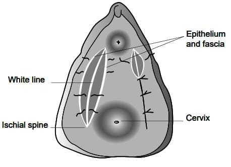 Posterior vaginal wall prolapse
