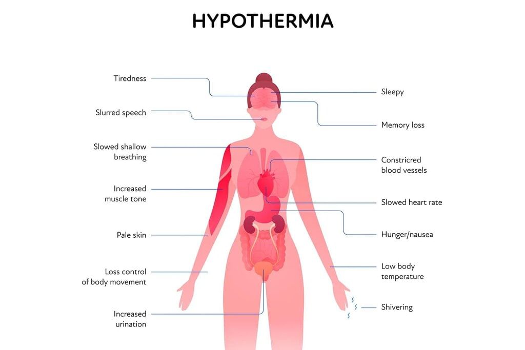 Effects of Cold and Heat Chapter Notes | Forensic Medicine and Toxicology (FMT) - NEET PG