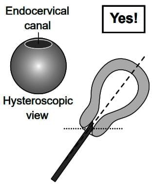 Diagnostic Hysteroscopy