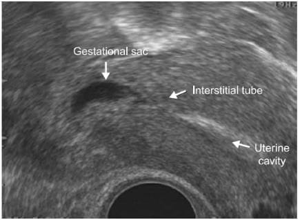 Interstitial ectopics