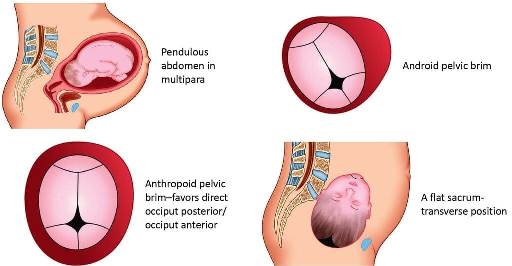 Factors favoring malposition