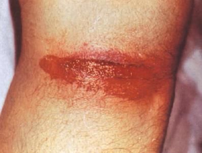Firearms and Explosive Injuries - 3 Chapter Notes | Forensic Medicine and Toxicology (FMT) - NEET PG
