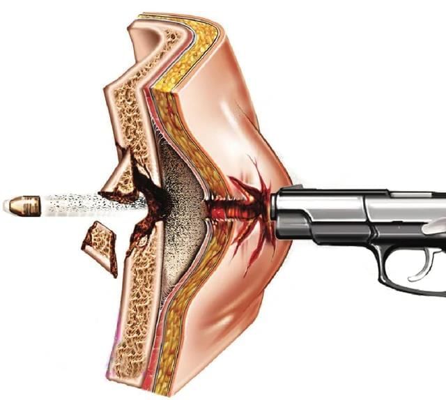 Firearms and Explosive Injuries - 3 Chapter Notes | Forensic Medicine and Toxicology (FMT) - NEET PG