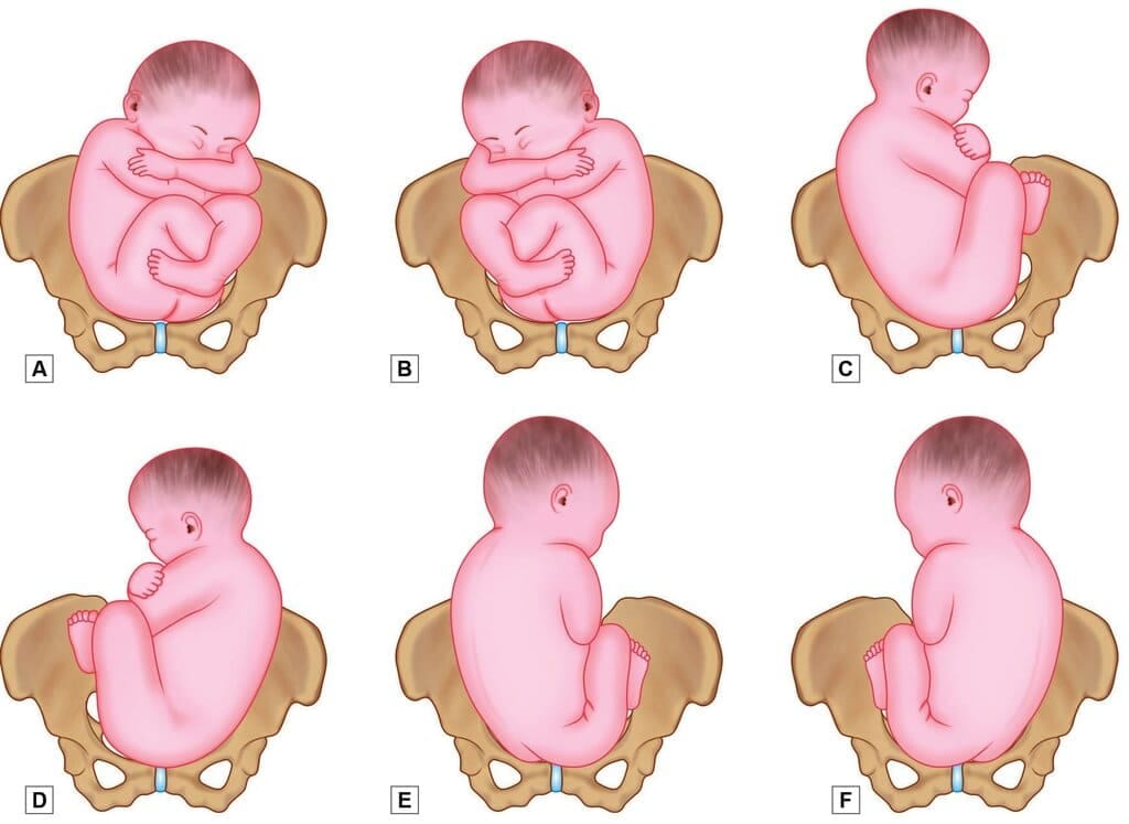  Positions in breech presentation. A. Right sacroposterior; B. Left sacroposterior; C. Right sacrolateral; D. Left sacrolateral; E. Right sacroposterior and F. Left sacroposterior 