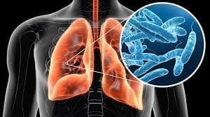 Legionnaire`s Disease