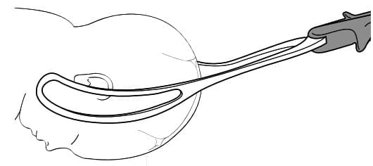 Choice of instruments - forceps/ventouse