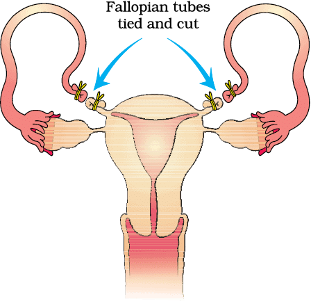 NEET Previous Year Questions (2014-2024): Reproductive Health | Biology Class 12