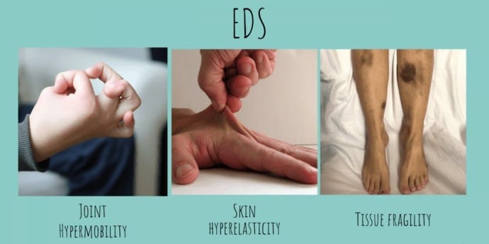 Ehlers-Danlos Syndromes