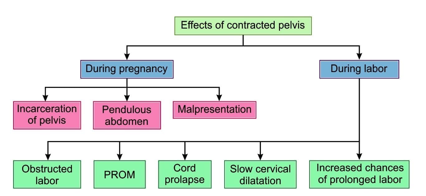 Effects of contracted pelvis on pregnancy or labor