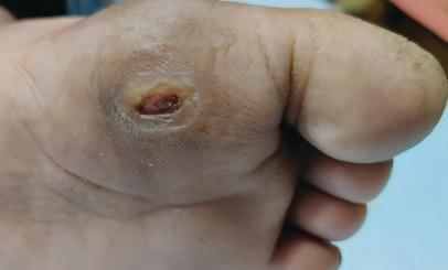 Hansen’s Disease Chapter Notes | Dermatology and Venereology - NEET PG