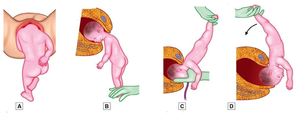 Burns Marshall maneuver. A. Let the baby to hang by its own weight until nape of neck comes under pubic arch; B. Hold his feet; C. With delivery of face and mouth, suction mucus should be performed; D. Swing his head clear