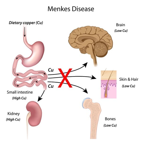 Menkes Disease