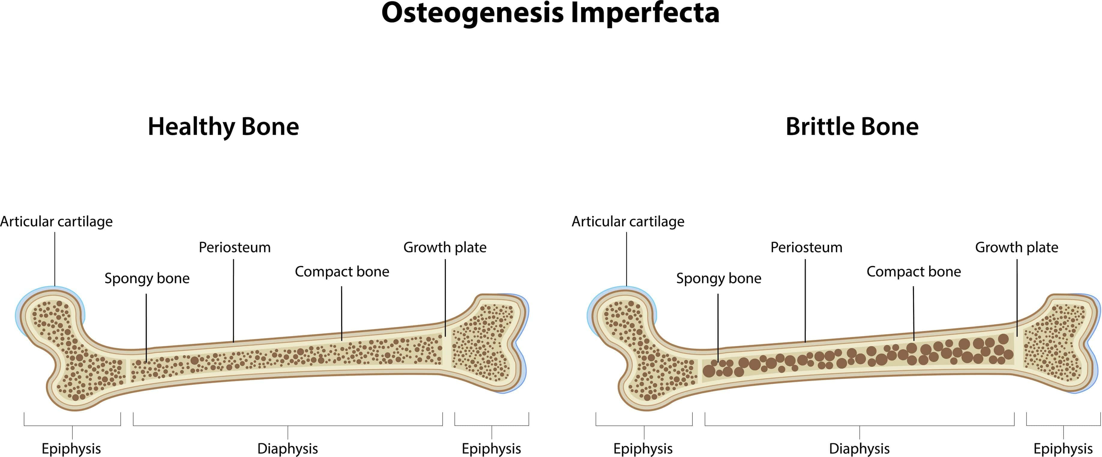 Osteogenesis Imperfecta