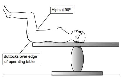 Patient position forhysteroscopy