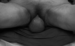 Vaginal vault prolapse